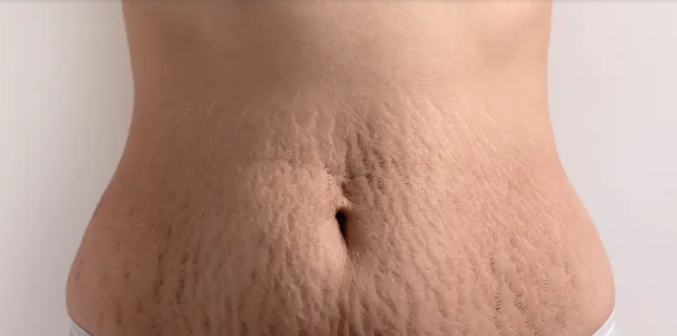 Pregnancy and herbs - stretch marks, how herbs can help