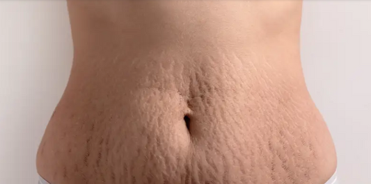 Pregnancy and herbs - stretch marks, how herbs can help